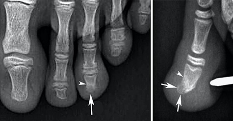Radiographs showing heterogenous density of the distal phalange of the third toe on the anteroposterior view (arrow in A) and a hypertrophy with low density of the dorsal part of this phalangeal tuft on the lateral view (arrows in B). Note also a discrete densification of the adjacent bone (arrowheads).