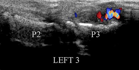 Dorsal view of color Doppler ultrasound showing the hypertrophy of the soft tissues near the phalangeal tuft, with a pattern of hypervascularization.
