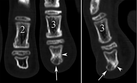 CT reconstruction images showing a small central lucent bone area in the phalangeal tuft on the coronal plane (arrow in A) and a focal dorsal prominence of the tuft with lucent content (arrow) on the sagittal view (B). Note also the sclerosis of adjacent bone (arrowheads).