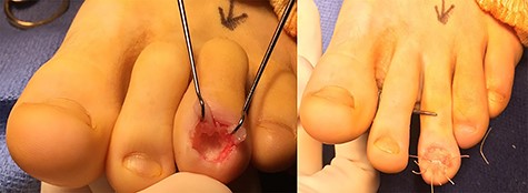 (A and B): peroperative views. The nail was removed and the dorsal part of the phalanx tuft was en-bloc resected (A). The nail was reinserted and sutured (B).