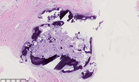 Histologic appearance showing a nodule measuring 3 × 2 mm, containing an immature osteoid matrix, bordered by osteoclast with many prominent vessels, and surrounded by peripheral osteosclerosis.