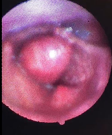 Clinical photograph showing the large cystic swelling arising from the right ventricle.