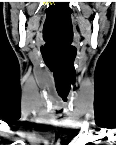 Coronal CT of neck showing the internal and external components of the laryngocoele, in relation to the thyrohyoid membrane.