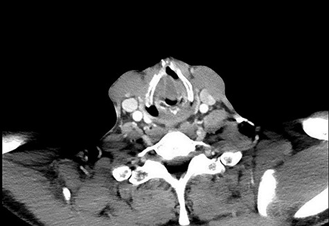 Axial CT showing obstruction at the level of the vocal cords. Media: video showing the laryngocoele.