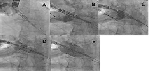 (A) The Sapien S3 did not pass into the aortic valve, and the Certitude system bounced back toward reverse direction; (B) the Sapien S3 was forcefully pushed together with the Certitude system, and the Sapien S3 finally came into the aortic valve; (C) the Certitude system was pulled back to enable dilatation; (D) the Sapien S3 was slowly deployed to avoid malposition; (E) the Sapien S3 was completely deployed