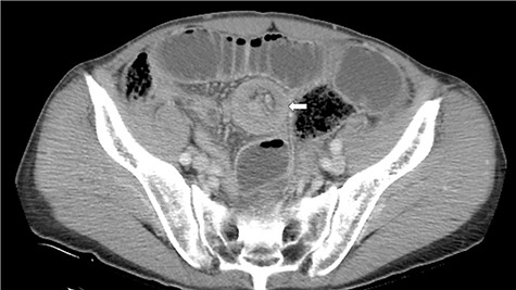 CT discloses a typical target sign over the small intestine (arrow).