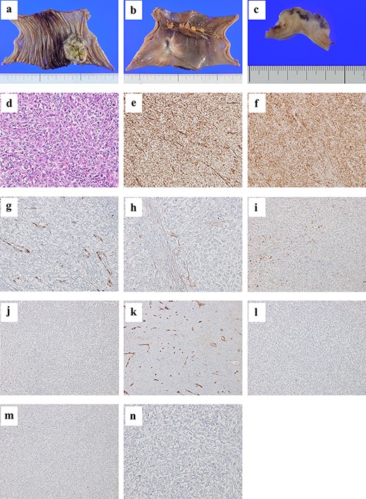 A tumor of size 35 mm is found from the mucosal to the subserosal layer of the jejunum (a, b, and c); the tumor is composed of sheets of epithelioid cells with high nuclear grade (×20 magnification hematoxylin and eosin staining) (d); immunohistochemical examination reveals tumor cells positive for vimentin (e), calretinin (f), WT-1 (g), D2-40 (h) and CK7 (i), and negative for CEA (j), CD34 (k), c-kit (l), CK5/6 (m) and CK20 (n).