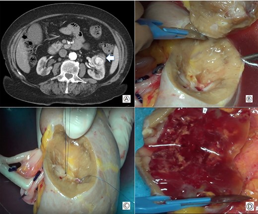 (A) Preoperative computed tomography: the white arrow shows the renal mass; (B) removal of the tumor during bench surgery; (C) suture of the renal calices during bench surgery; (D) macroscopic examination of the surgical piece.