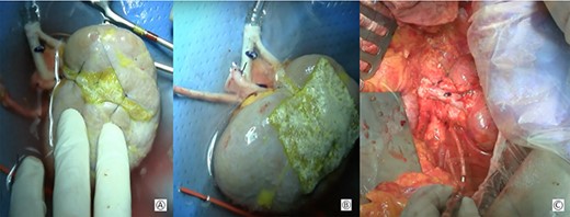 (A) Approximation of the margins of the section with interposition of a hemostatic sponge; (B) kidney at the end of the bench surgery; (C) intraoperative view after vascular anastomoses.