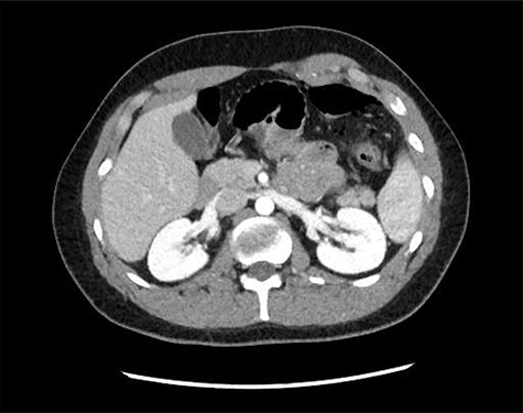Axial computed tomography image demonstrating mesenteric stranding and free gas locules.