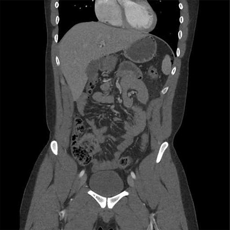 Coronal computed tomography image demonstrating free air.