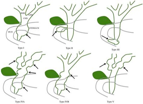 Todani classification of CC.