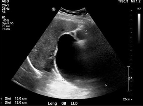 Ultrasound showing obscured CBD, 3 mm gallbladder wall, and a cystic lesion communicating with the CBD and a large gallbladder cyst.