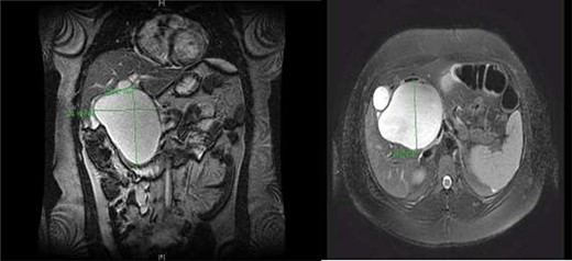 CC with mass effect on liver and duodenum in coronal (A) and axial (B) views.