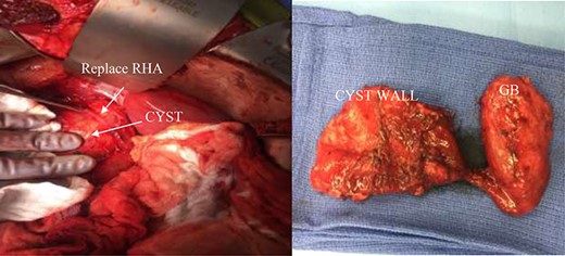 (Left) intra-operative CC and replace right hepatic artery. (Right) decompressed gallbladder (GB) and decompressed CC.