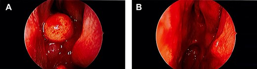 Intraoperative endoscopic images. (A) Large, spherical, well-circumscribed polypoidal tumour in the left nasal passage; (B) post-operative image showing complete excision of the lesion.