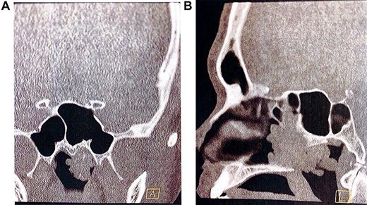 Pre-operative computed tomography of the nasal passage and sinuses. (A) Coronal CT sinuses (bone algorithm) demonstrating left nasopharyngeal space ‘polypoid’ type opacification, with evidence of intralesional calcification; (B) sagittal CT sinuses (bone algorithm) demonstrating a large polypoidal type opacification obstructing the posterior nasal choanae.