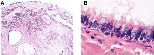 (A) Haematoxylin and eosin staining of lesion demonstrating cystic and glandular structures within a fibrous stroma (light microscopy, ×4); (B) haematoxylin and eosin staining of lesion demonstrating cysts lined by ciliated respiratory type epithelium (light microscopy, ×40).