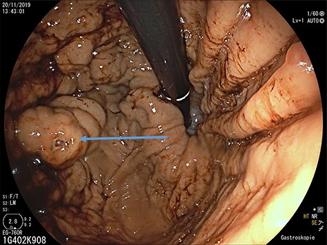 Upper gastrointestinal endoscopy: gastric varices (arrow) in the fundus after previous bleeding.