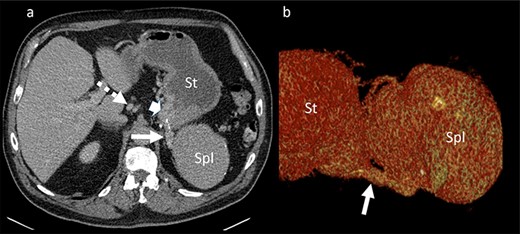 Portal venous phase CT of the upper abdomen (a) with a 3D reconstruction (b); note the gastric varices (arrowhead) and dilatation of short gastric veins (solid arrow) and coronary vein (dashed arrow); St: stomach; Spl: accessory spleen.