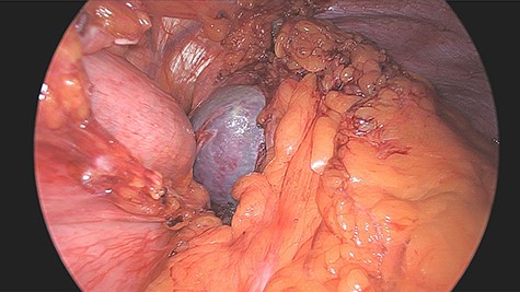 Intraoperative finding of the accessory spleen.