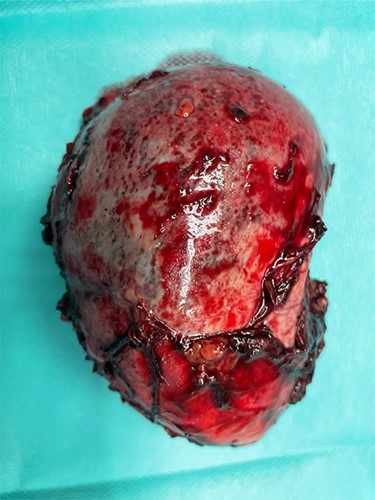 Resected specimen.