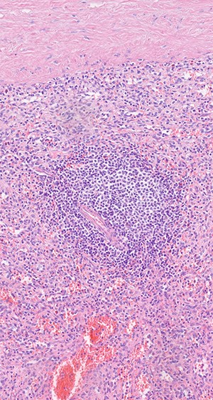 Histologic examination shows red and white pulp as main compartments of the spleen; B-cell follicle with geminal center, mantle- and marginal-zone; perifollicular red pulp with sinus; HE×20.