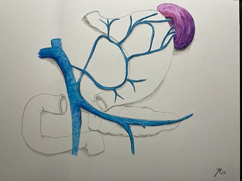 Pathophysiology of left side portal hypertension with gastric varices.