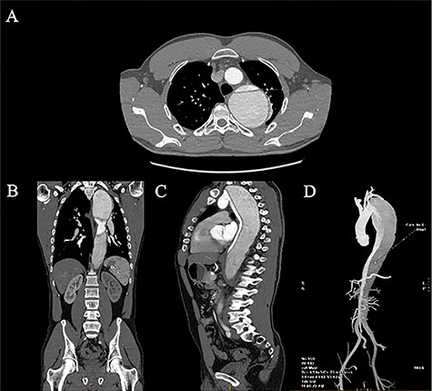 April 2020 CT aortogram demonstrating a large 72.7 mm × 68.6 mm fusiform aneurysm: (A) axial slices, (B) coronal slices, (C) sagittal slices, and (D) 3D reconstruction.