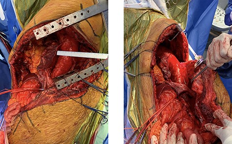 Intraoperative photographs demonstrating a 70 mm TAAA.