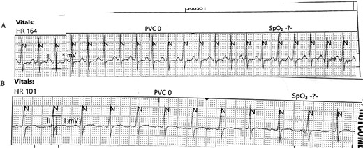 (A) Telemetry demonstrating a heart rate of 164 bpm on mobilization and (B) Telemetry demonstrating a heart rate of 101 bpm on returning to sitting position.