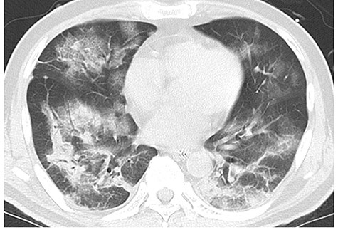 Chest CT at the onset of COVID-19 showing bilateral patchy ground-glass opacities and infiltrative shadows.
