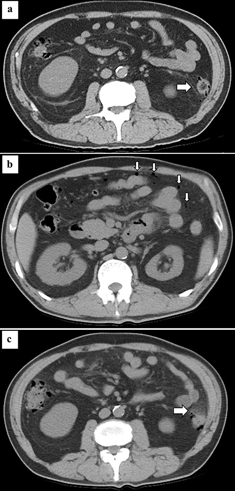 Abdominal CT at the onset of COVID-19 showing diverticulum of the descending colon (arrow) (a). Abdominal CT at the onset of pan-peritonitis showing free air in the abdominal cavity (arrow) (b) and increased fat density surrounding the descending colon (arrow) (c).