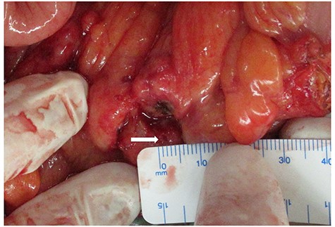 Pinhole perforation in the descending colon is observed (arrow).