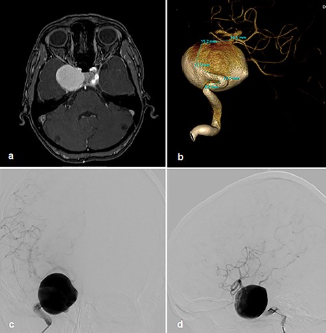 Right cavernous ICA Aneurysm on MR TOF angiography (a); DSA 3D angiogram (b); p–a projection angiogram (c); lateral angiogram (d).