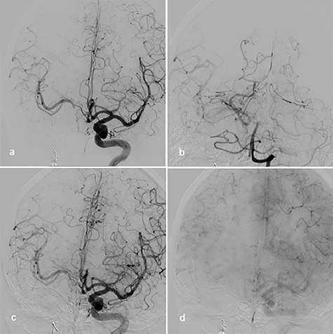 BOT, left ICA angiogram with right-sided collateral perfusion (a); collateral perfusion via posterior communicating artery (b); left ICA angiogram during BOT and hypotensive challenge, arterial phase (c); venous phase (d).