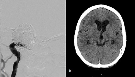 Coiling of giant aneurysm and parent vessel occlusion, p–a angiogram (a), CT scan on Day 1 (b).