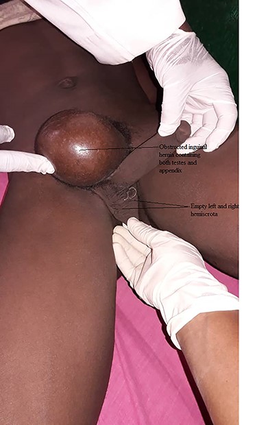 Preoperative picture showing obstructed inguinal hernia and empty scrotum.