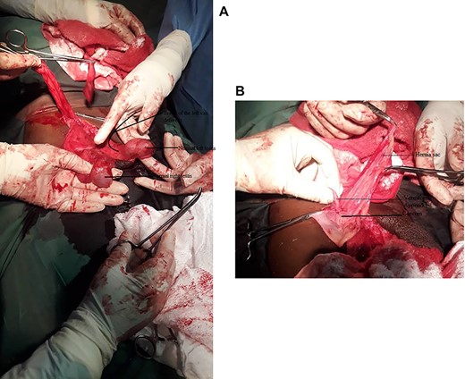 (A) Intraoperative picture showing the right and left testes. (B) Intraoperative picture showing the vermiform appendix, caecum and hernia sac.