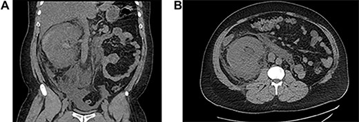 A: peri-renal hematoma. B: perirenal hematoma: