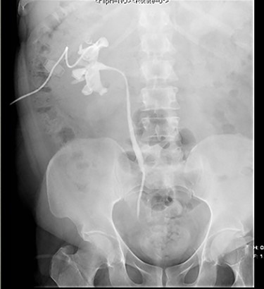 Antegrade pyelogram post drainage and insertion of nephrostomy tube.