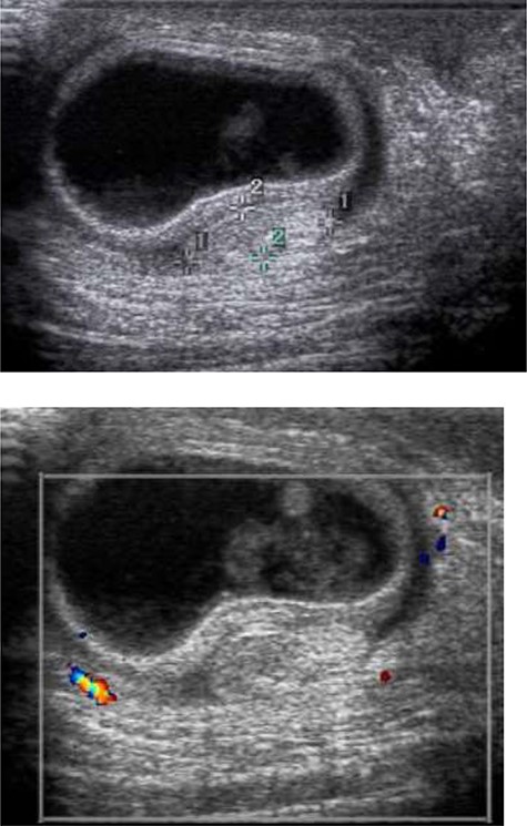 Ultrasound of the scrotum was performed assessing gray scale appearance and color Doppler flow. The right testis and inguinal region demonstrates a right inguinal hernia containing a loop of bowel within the right scrotum with echogenic bowel contents. A hyperechoic ovoid structured, favored to represent the right testicle, is seen measuring ~1.0 × 1.0 × 0.4 cm. There is no sonographic evidence of vascular flow with the right testicle.