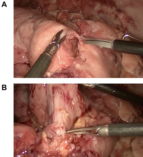 (A) gastric greater curvature plication, (B) pylorus obstruction.