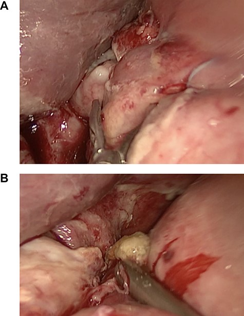 (A) Nissen wrap, (B) gastric perforation on the top of the wrap.