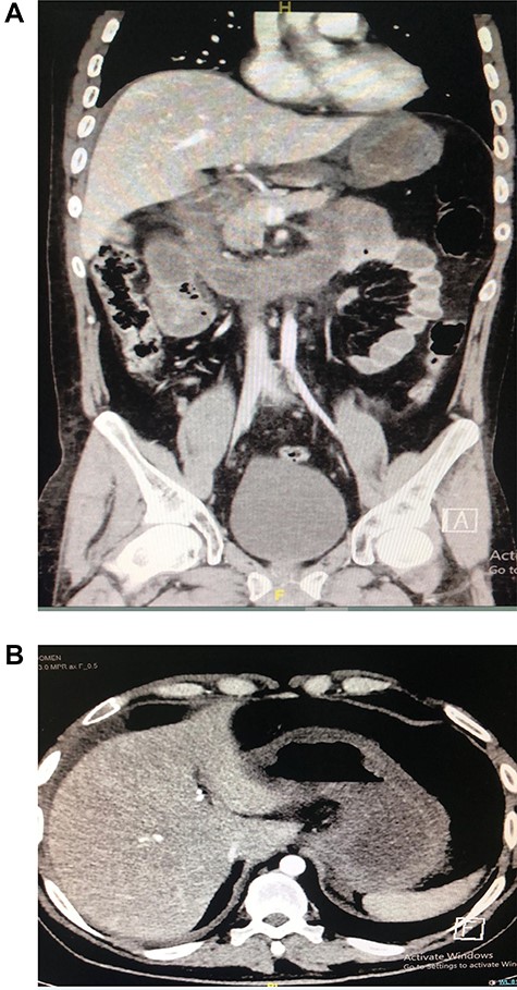 (A and B). CT showing segmental dilatation of the small bowel with diffuse circumferential wall thickening and suspected tow areas of transnational zones.