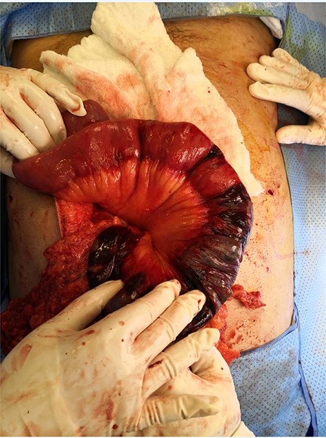 Ischaemic patches at the fourth and proximal 70 cm of jejunum.