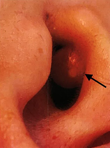Clinical photograph of the juvenile xanthogranuloma (arrow) obstructing the left external auditory canal.