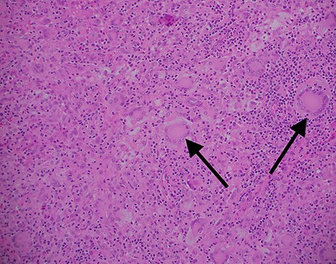 Haematoxylin and eosin stained ×100 magnification histopathology slide from excised xanthogranuloma highlighting characteristic Touton cells (arrow) amongst abundant monocytes.