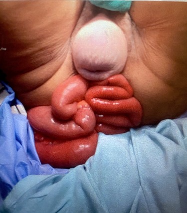Multiple small bowel loops eviscerated through anus and associated long-standing uterine prolapse.