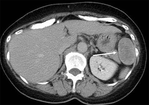 Radiological findings. Computed tomography showing a well-circumscribed soft tissue mass measuring 5.1 × 3.2 × 2.6 cm in the left anterolateral abdominal wall (white arrow).